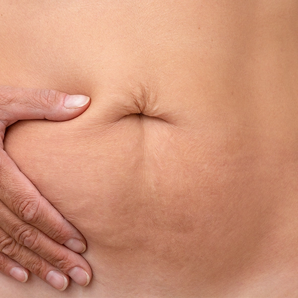 Abdominoplastik-Weinberger-Aesthetics
